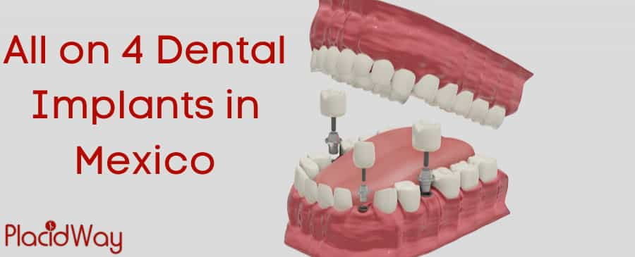 Implantes dentales All on 4 en México