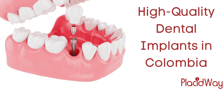 Implantes dentales de alta calidad en Colombia