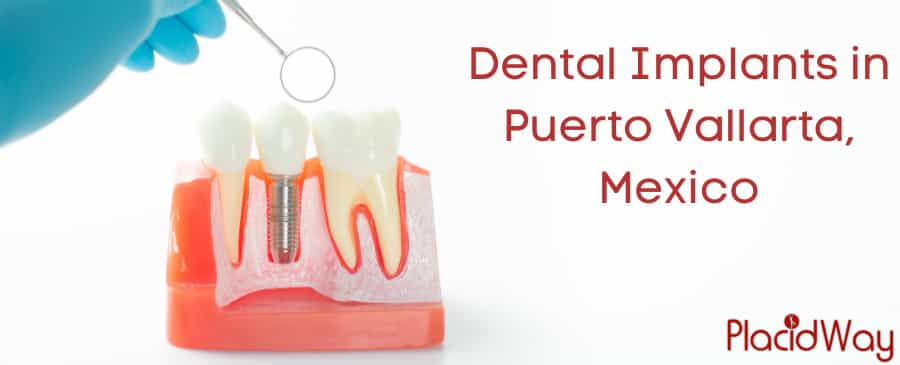 Implantes Dentales en Puerto Vallarta, México - Bajo Costo y Calidad