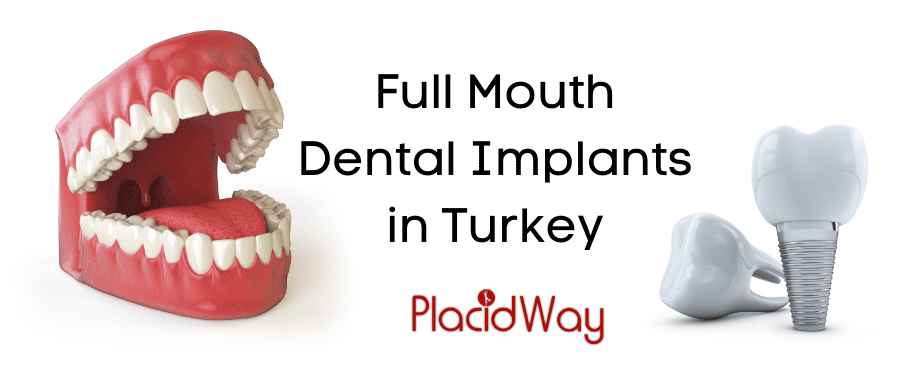 Implantes dentales de boca completa en Turquía: asequibles y seguros