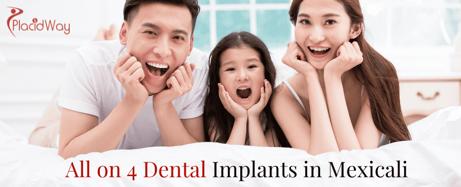 Implantes dentales All on 4 en Mexicali