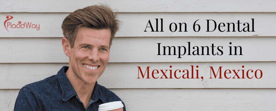 Implantes dentales All on 6 en Mexicali México