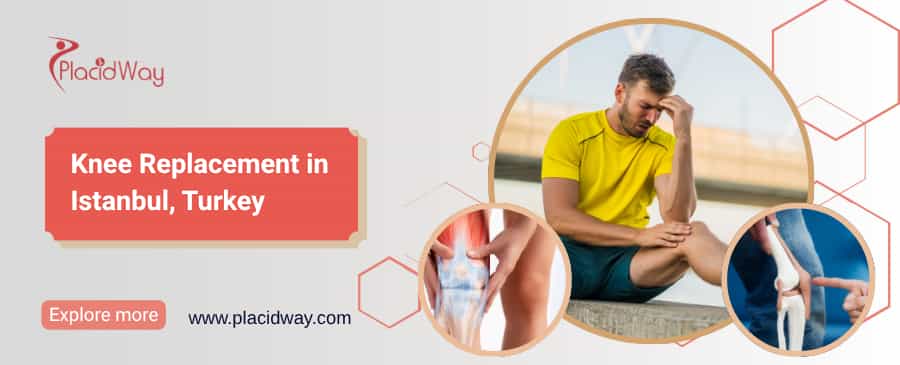 Reemplazo de rodilla en Estambul, Turquía thumbnail
