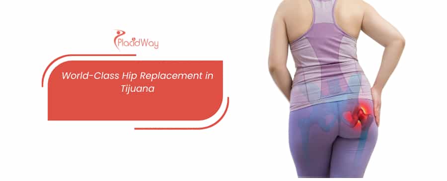 Reemplazo de Cadera en Tijuana - Mejore la Salud de su Cadera thumbnail