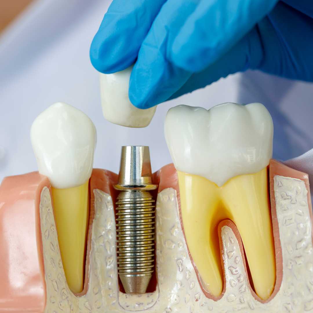 Implantes dentales All-on-4: México vs. EE. UU. - Guía completa