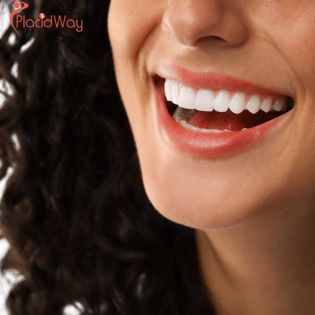 Implantes de arco completo All-on-4 en el extranjero para una transformación completa de la sonrisa y una recuperación más rápida