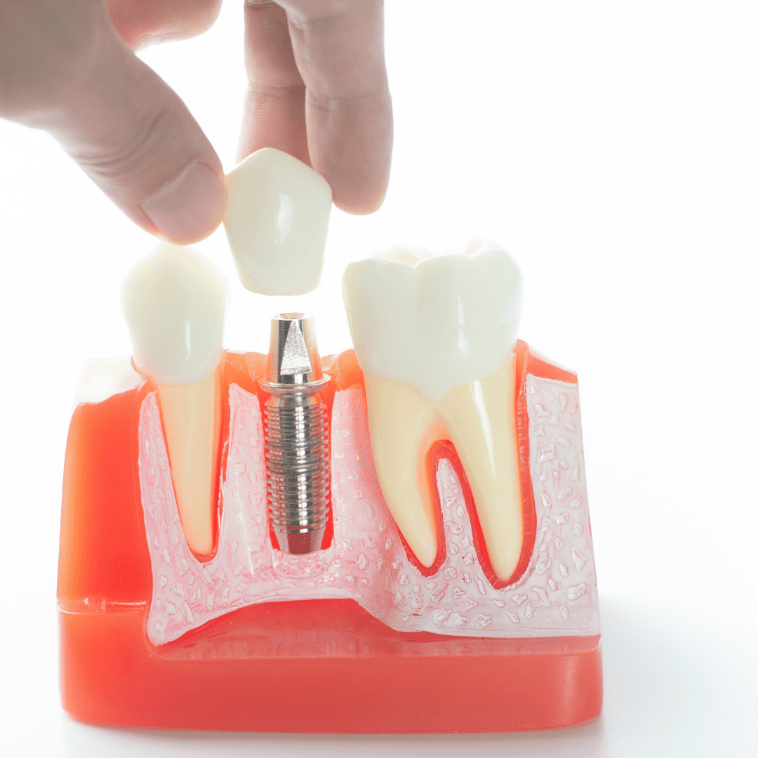 Implantes dentales en México