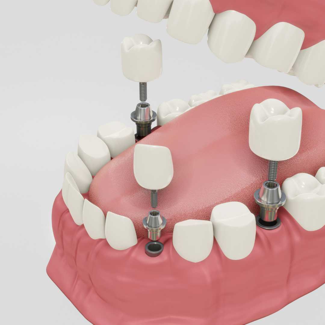 Implantes dentales All on 4 en Turquía