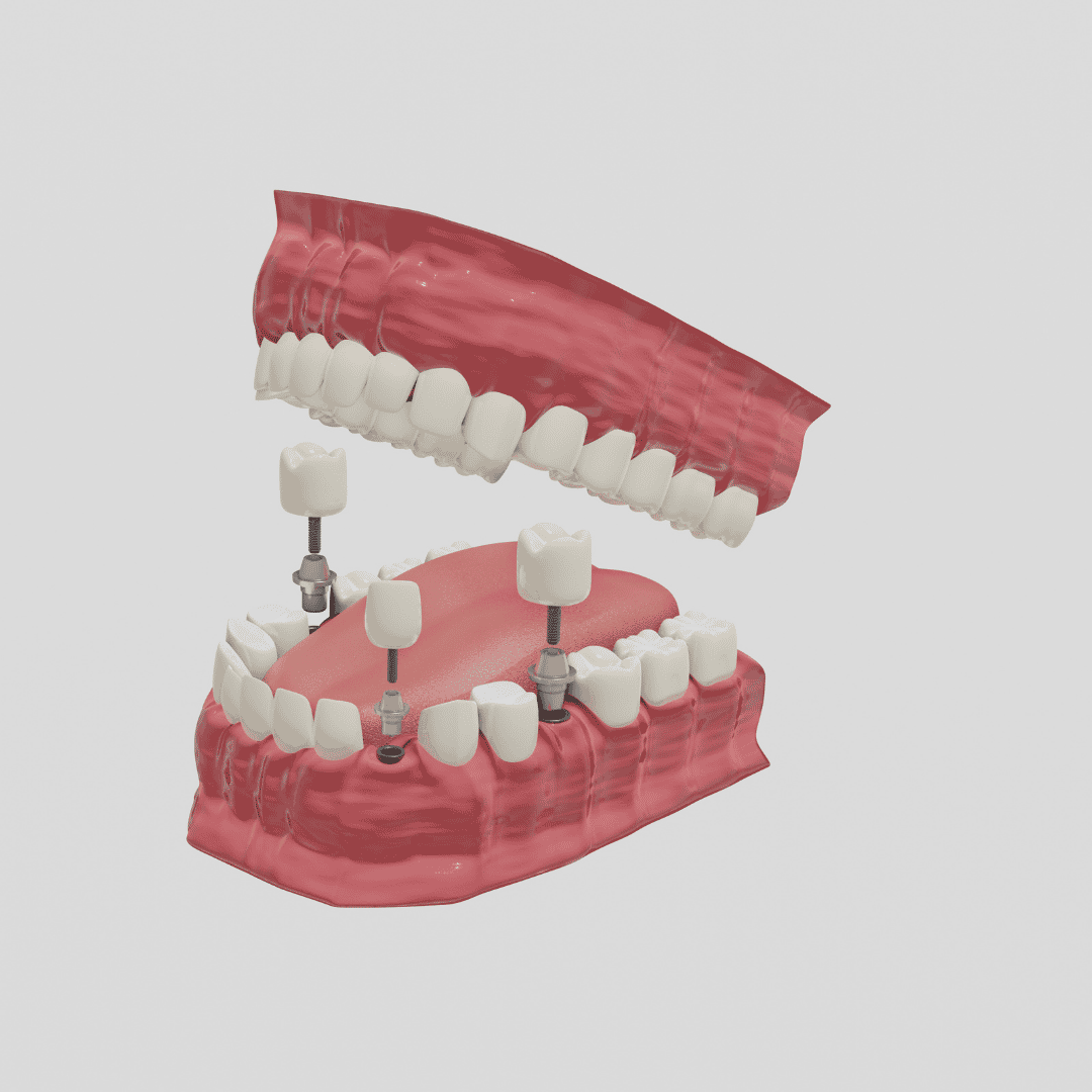 Implantes dentales All on 4 en México
