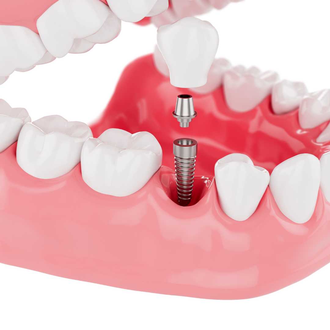 Implantes dentales de alta calidad en Colombia