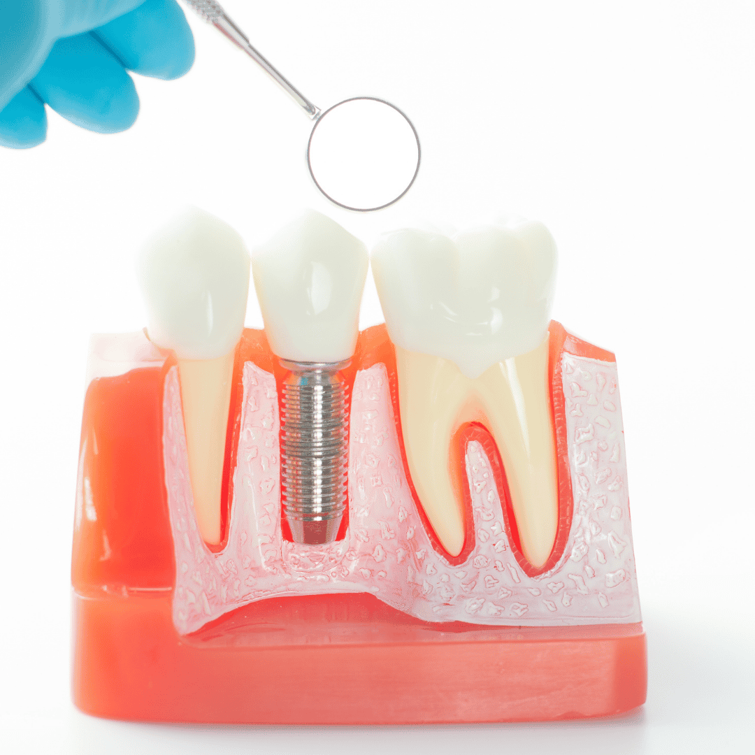Implantes Dentales en Puerto Vallarta, México - Bajo Costo y Calidad