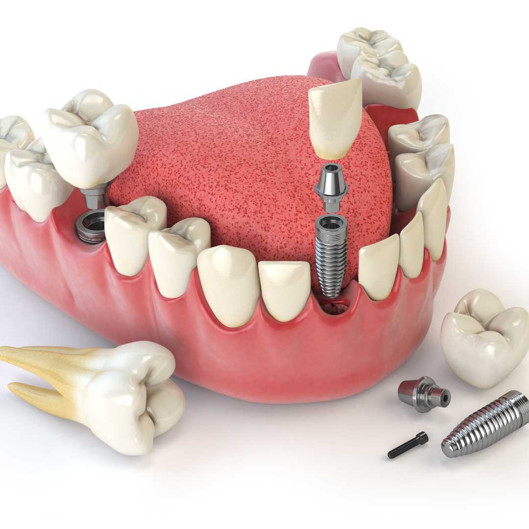 Todo sobre 4 Implantes Dentales en Los Algodones, México 