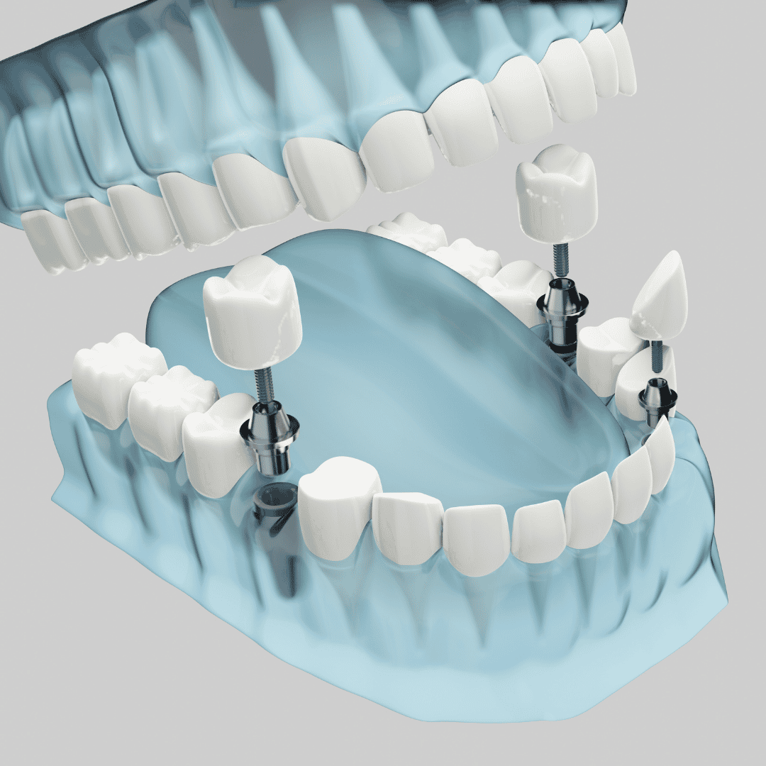 Implantes dentales All on 4 en Cancún, México