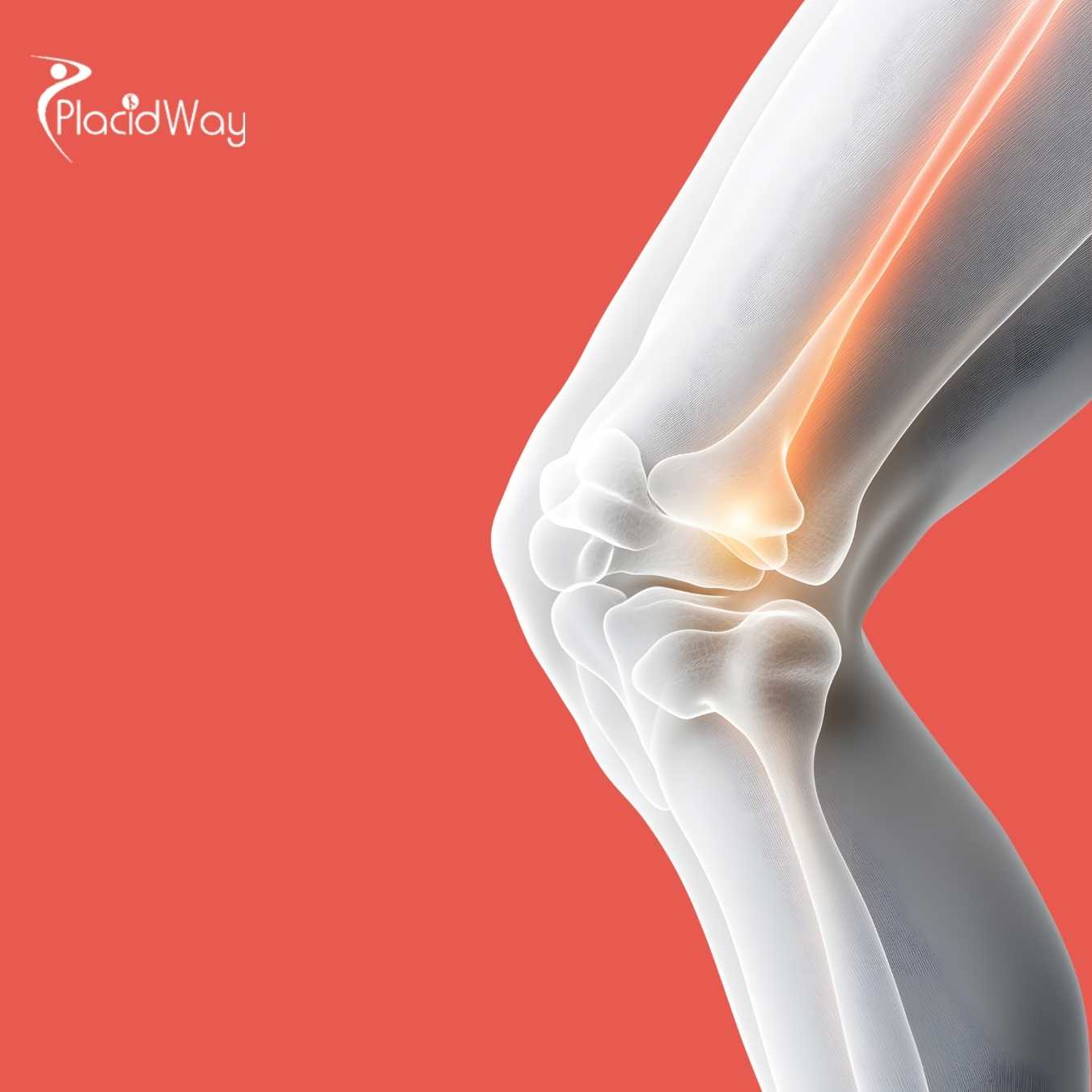 El mejor reemplazo de rodilla en Cancún, México, en un hospital de primera categoría