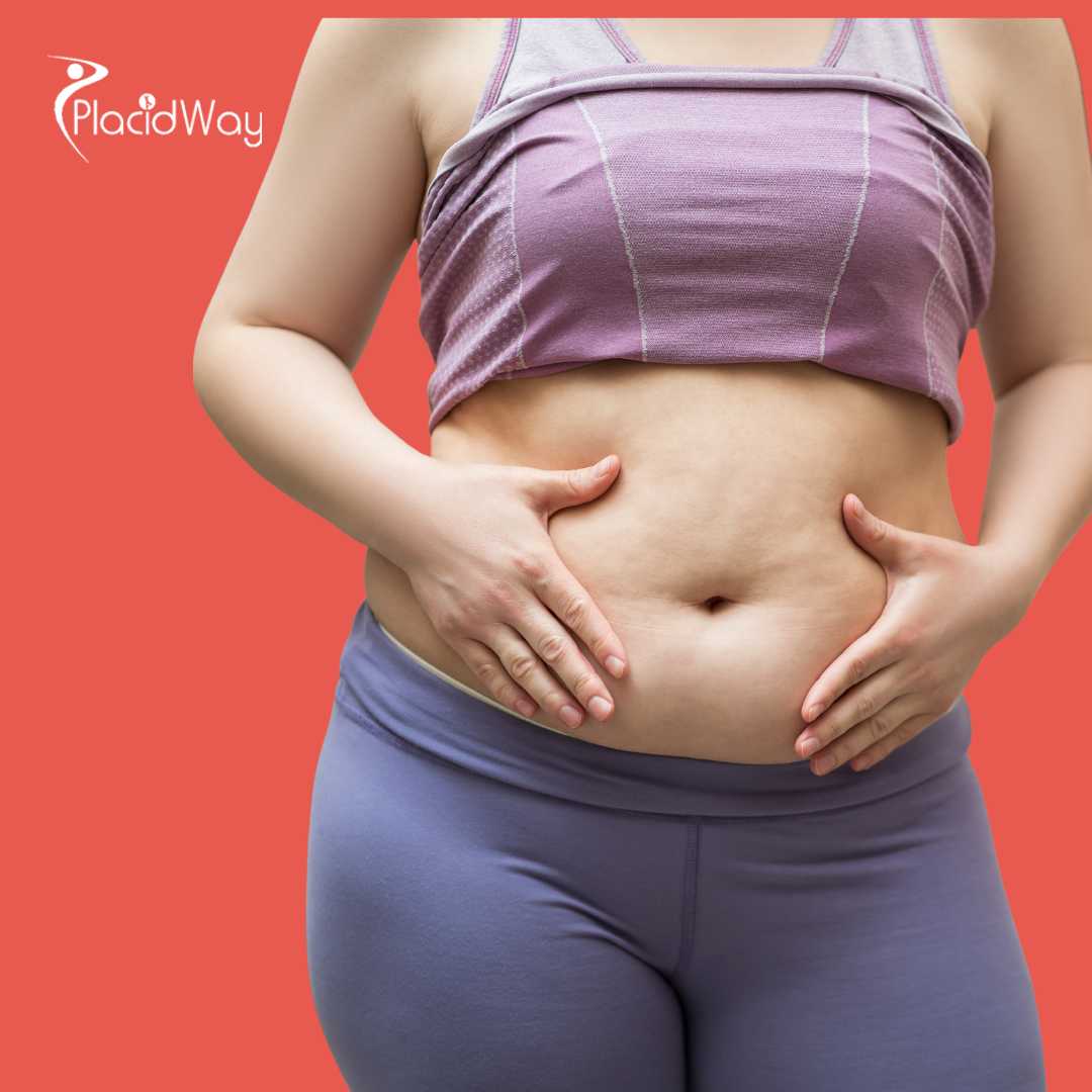 Abdominoplastia en Guadalajara México – ¡Recupera tu cuerpo de antes del embarazo!