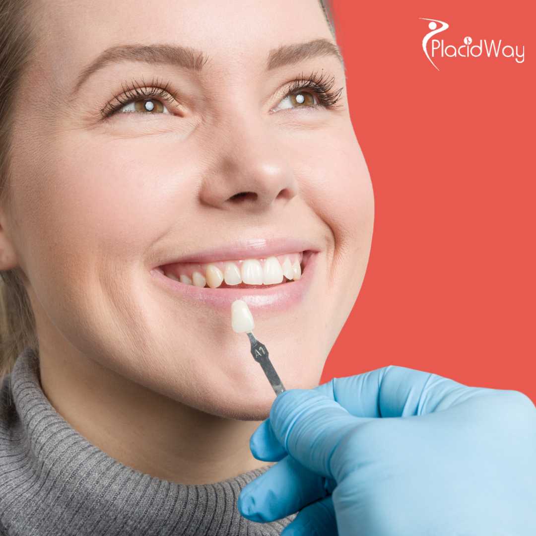 Carillas dentales en Cancún, México