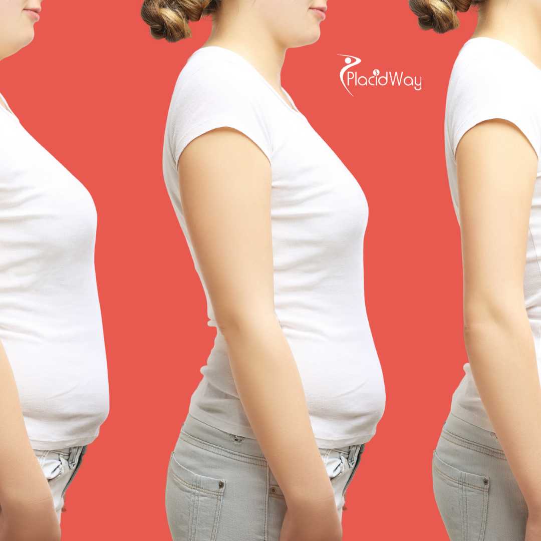 Cirugía de Manga Gástrica en Piedras Negras, México