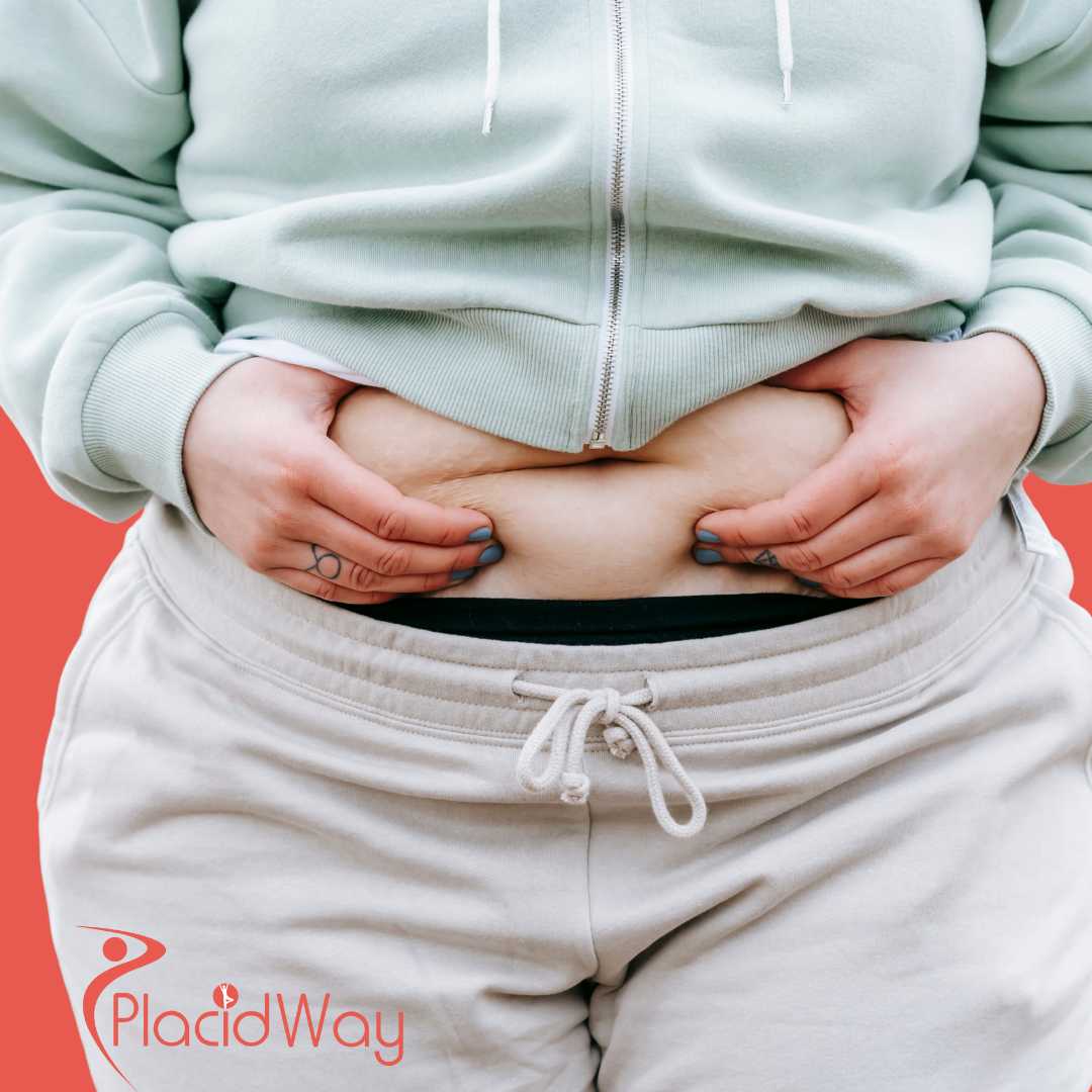 Abdominoplastia en Ankara, Turquía