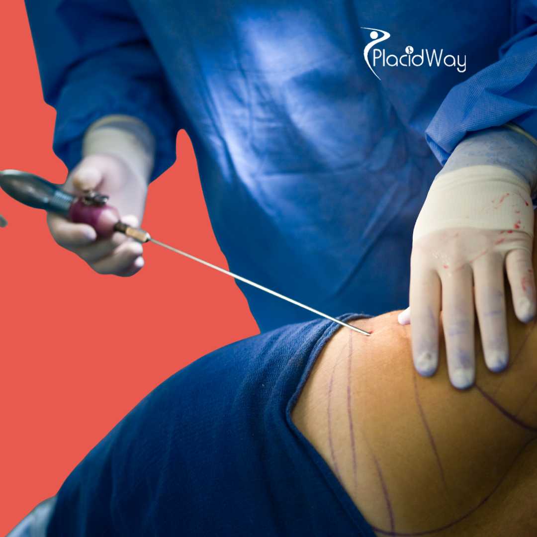 Liposucción en Santo Domingo, República Dominicana