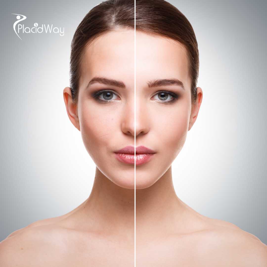 Mommy Makeover en la Ciudad de México, México