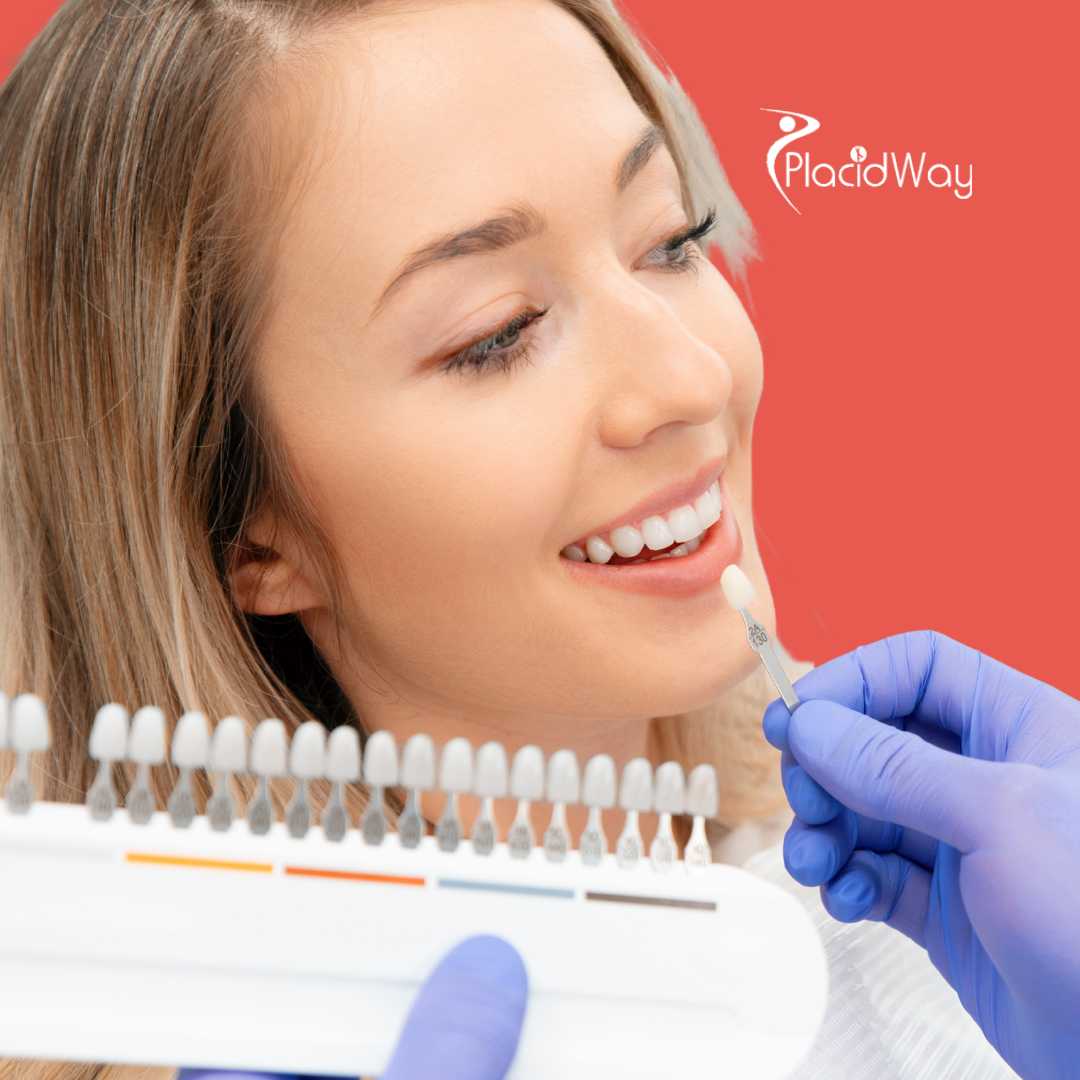 Carillas dentales en Tijuana, México 