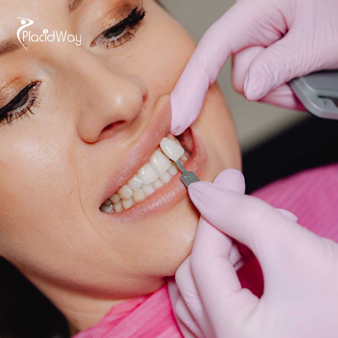 Carillas dentales en Estambul