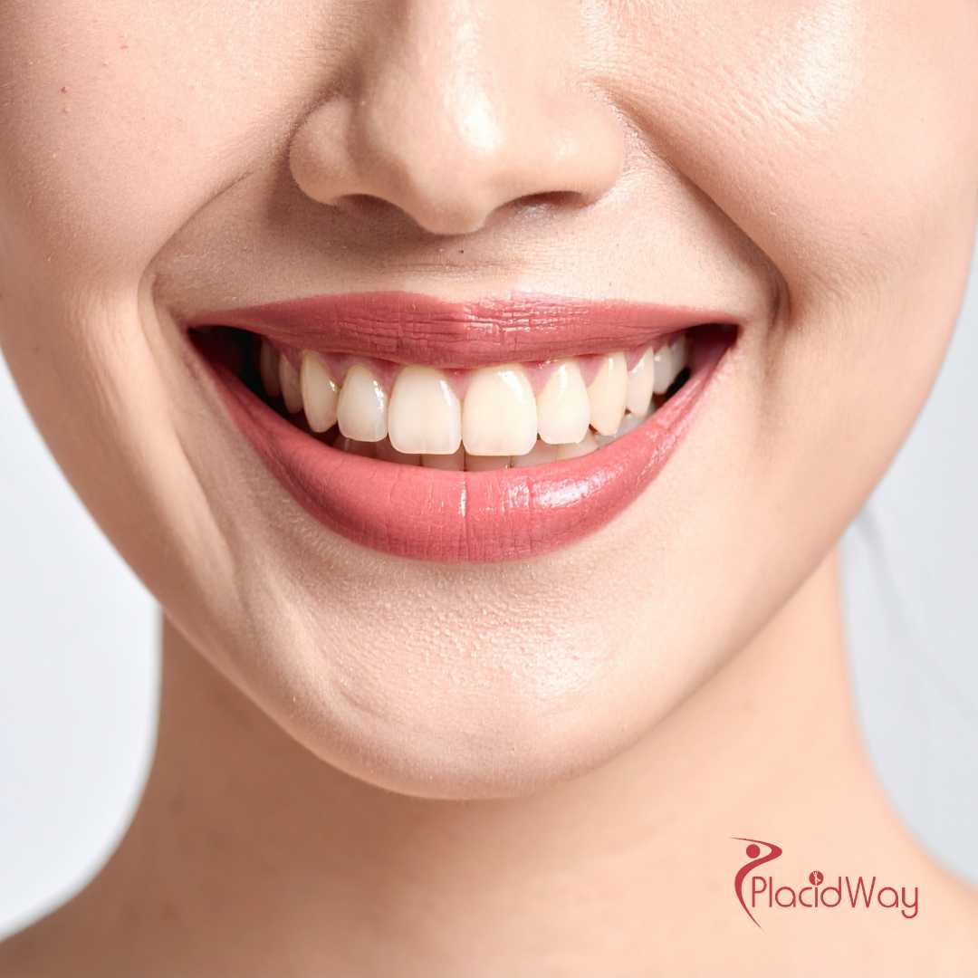 Implantes dentales All on 6 en Turquía