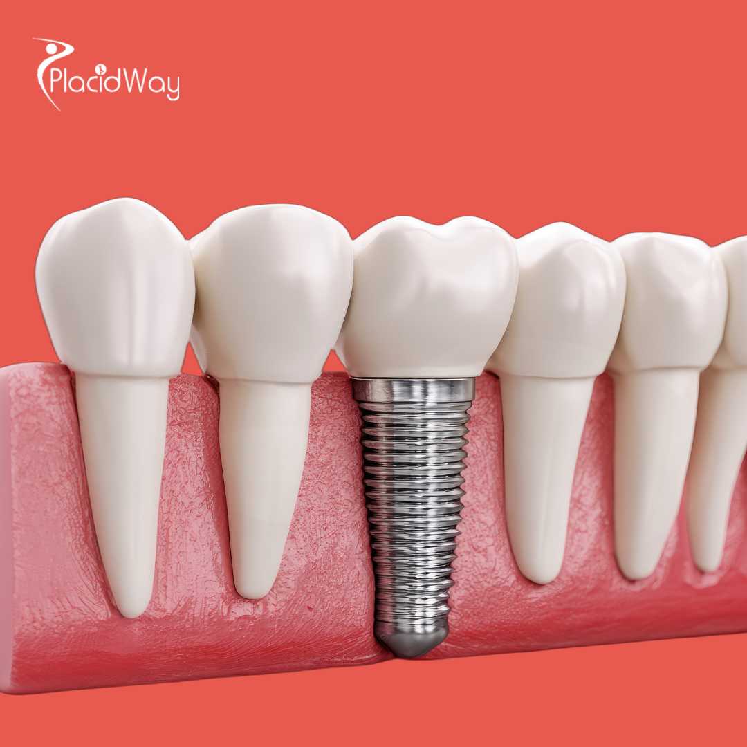 Coronas dentales en Izmir, Turquía