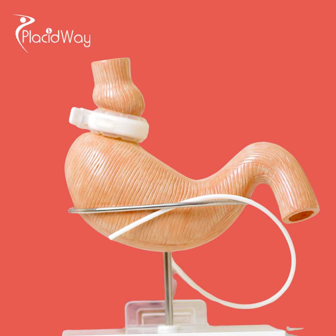 Cirugía Bariátrica en Cancún, México - La Guía Definitiva