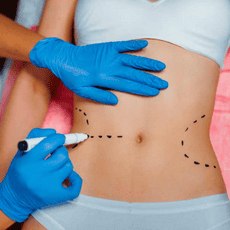 Liposuction Package in Merida, Mexico by Dr. Ernesto Acosta Abeyta