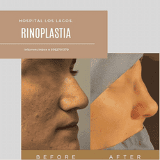 Paquete de Rinoplastia en Reynosa, México por Hospital Los Lagos 