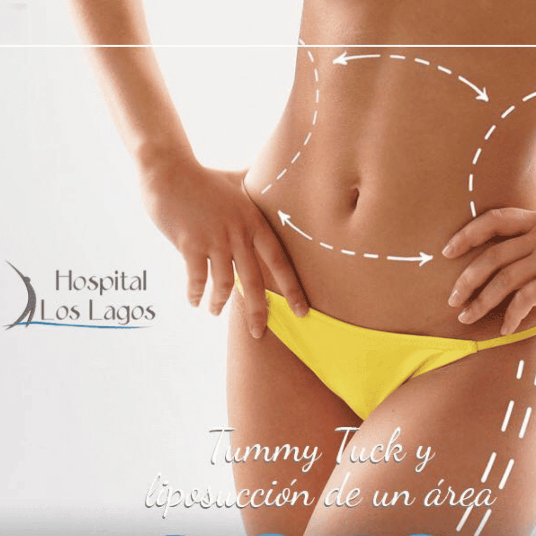 Abdominoplastia en México con Liposucción en Reynosa - $6800