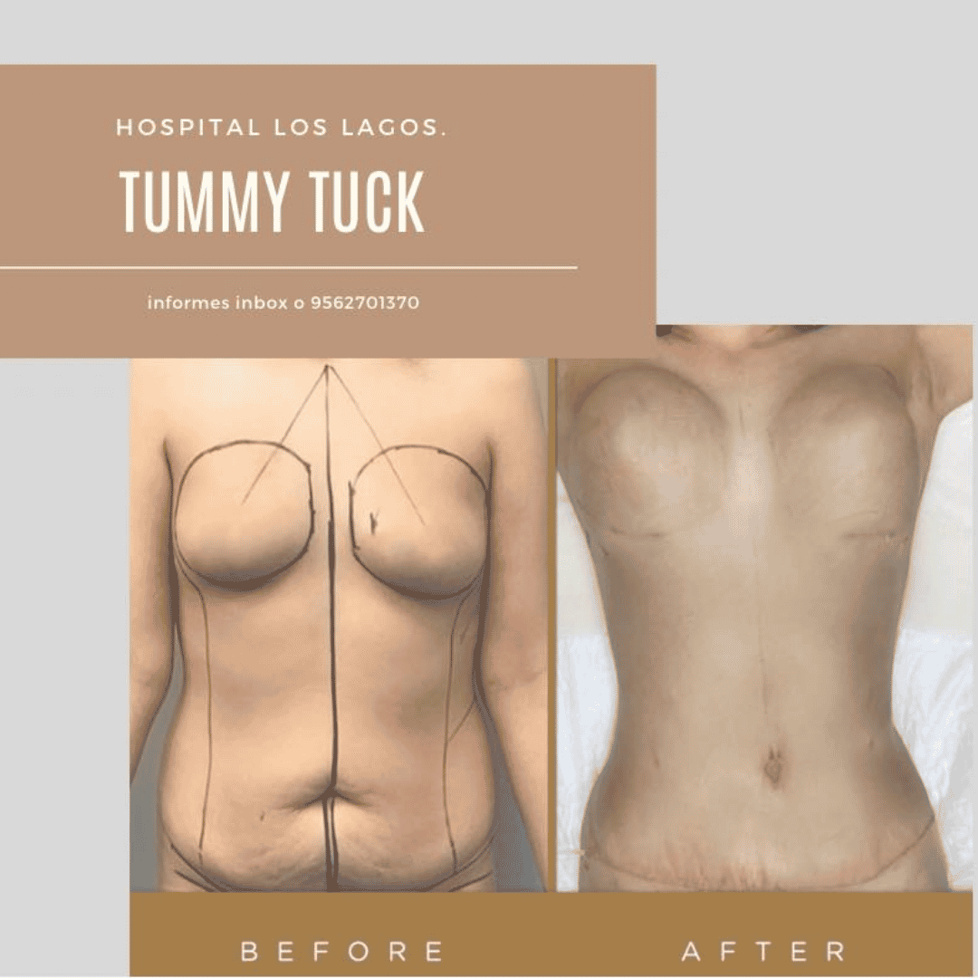 El paquete más económico para abdominoplastia en Reynosa, México: $3,700