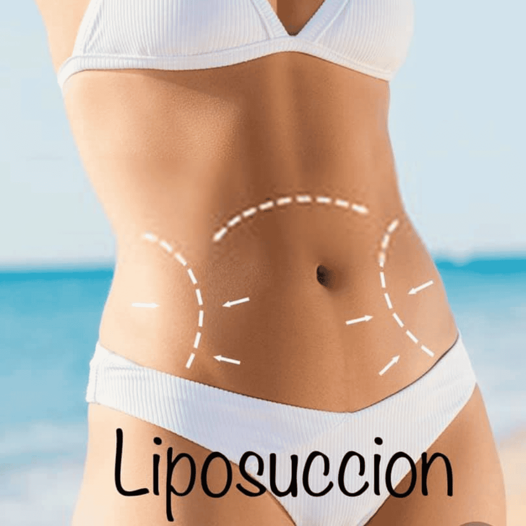 Liposucción superior en Reynosa, México en Hospital Los Lagos