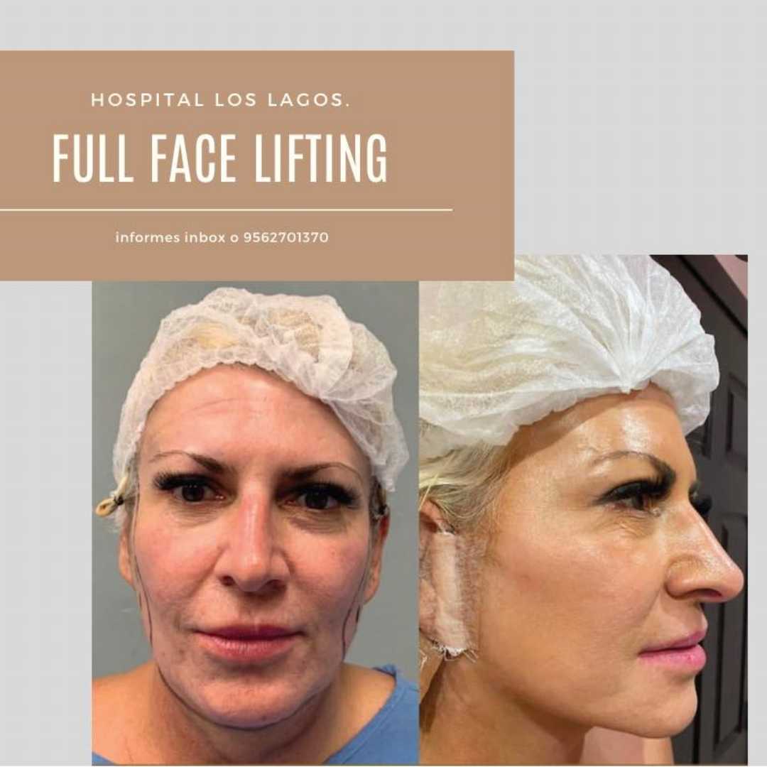 Paquete de lifting facial en Reynosa, México por Hospital Los Lagos