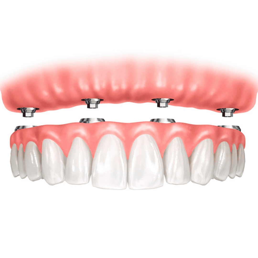 Full Dentures at Americas Dental Care Costa Rica