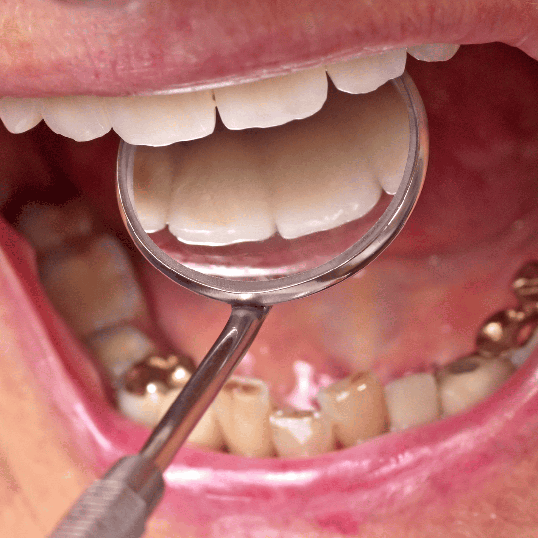 Paquete de corona de zirconio y endodoncia en Los Algodones, México, de Rancherito Dental