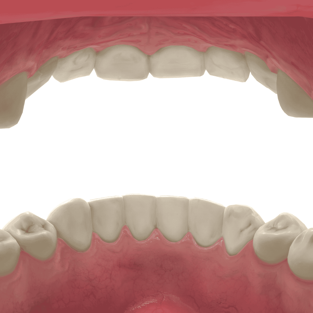 All-Inclusive Package For Dental Bridges in Mexico