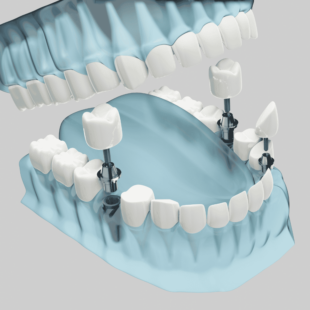 All on 4 Dental Implants Package in Tijuana, Mexico by Dental Solutions Tijuana