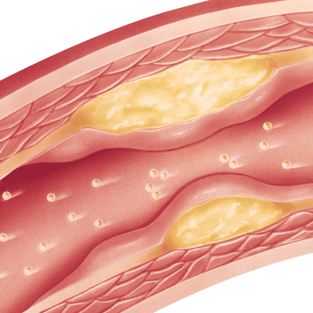 Paquete de Terapia con Células Madre para la Aterosclerosis en Stem Cells Kyron Colombia