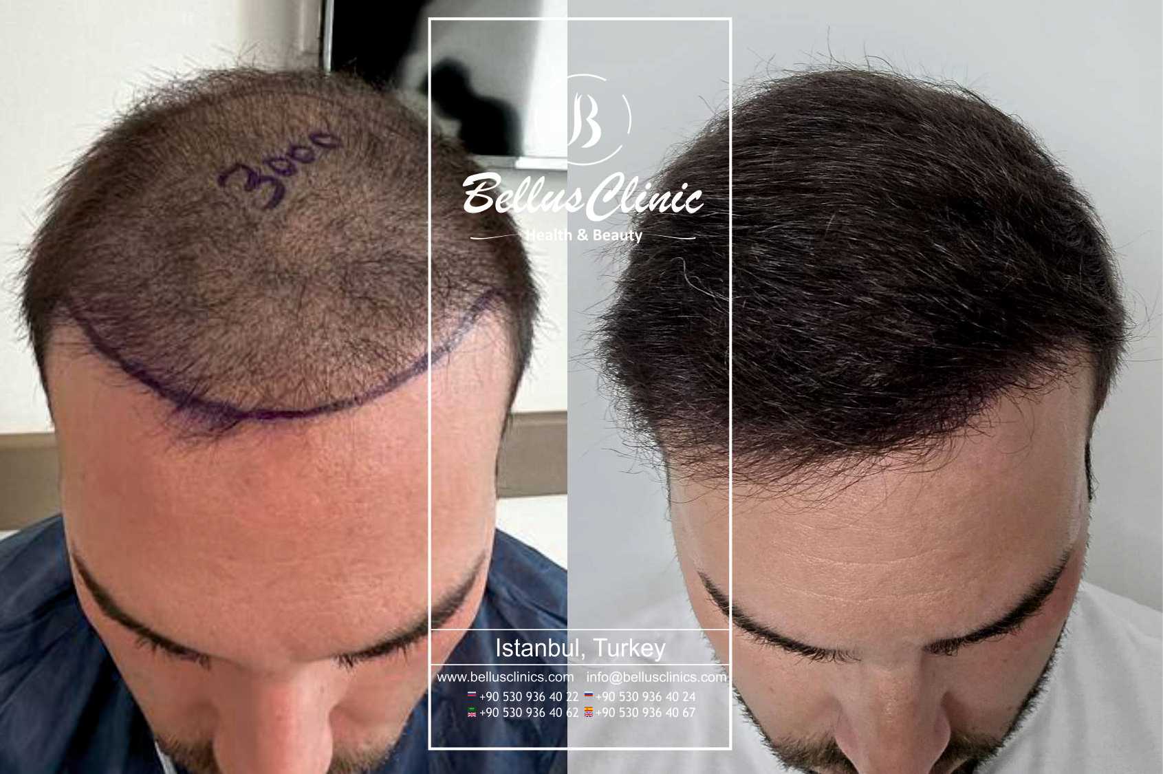 Paquete de trasplante de cabello DHI de la Clínica Bellus