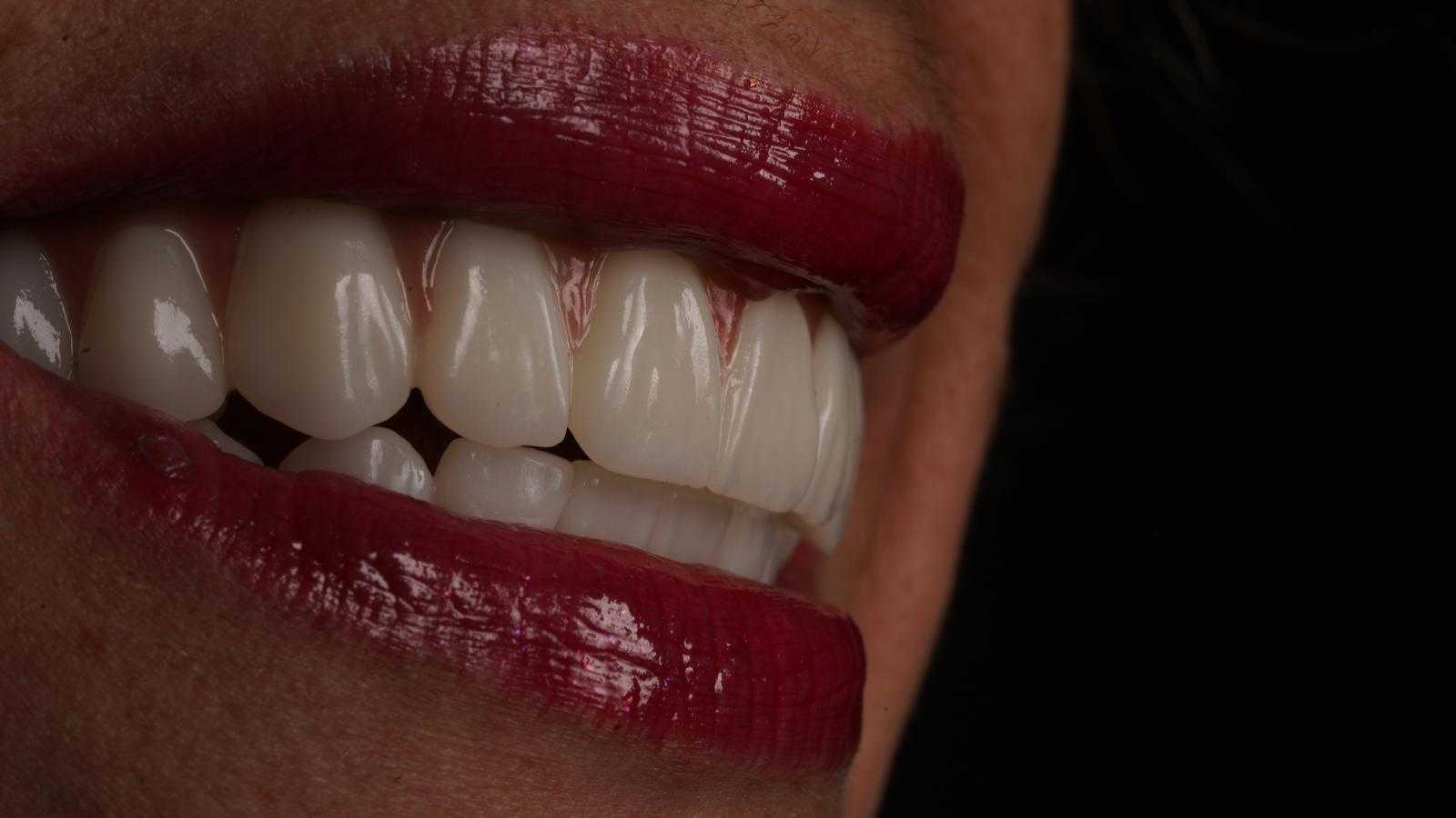 Tratamiento de sonrisa en Clinic Prime Estambul, Turquía