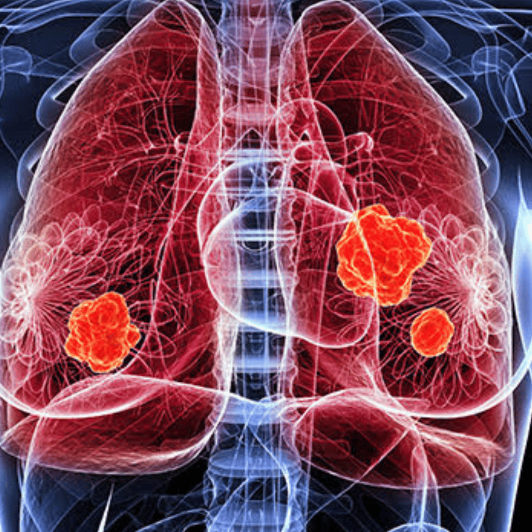 Vacunas cubanas terapéuticas contra el cáncer de pulmón