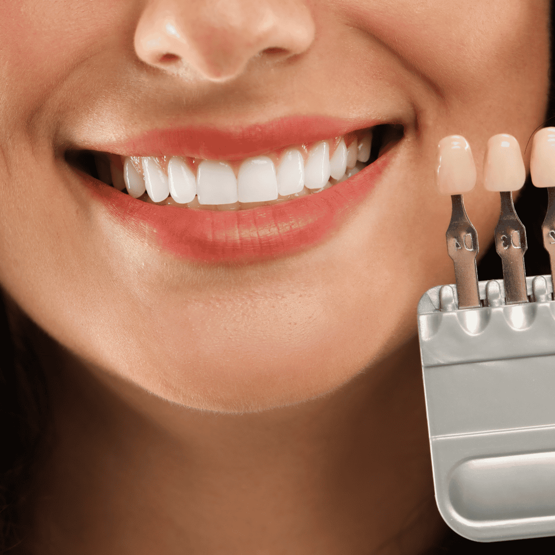 Cambio de imagen de sonrisa en Estambul - Sonrisa de Hollywood, implantes, coronas en Estambul