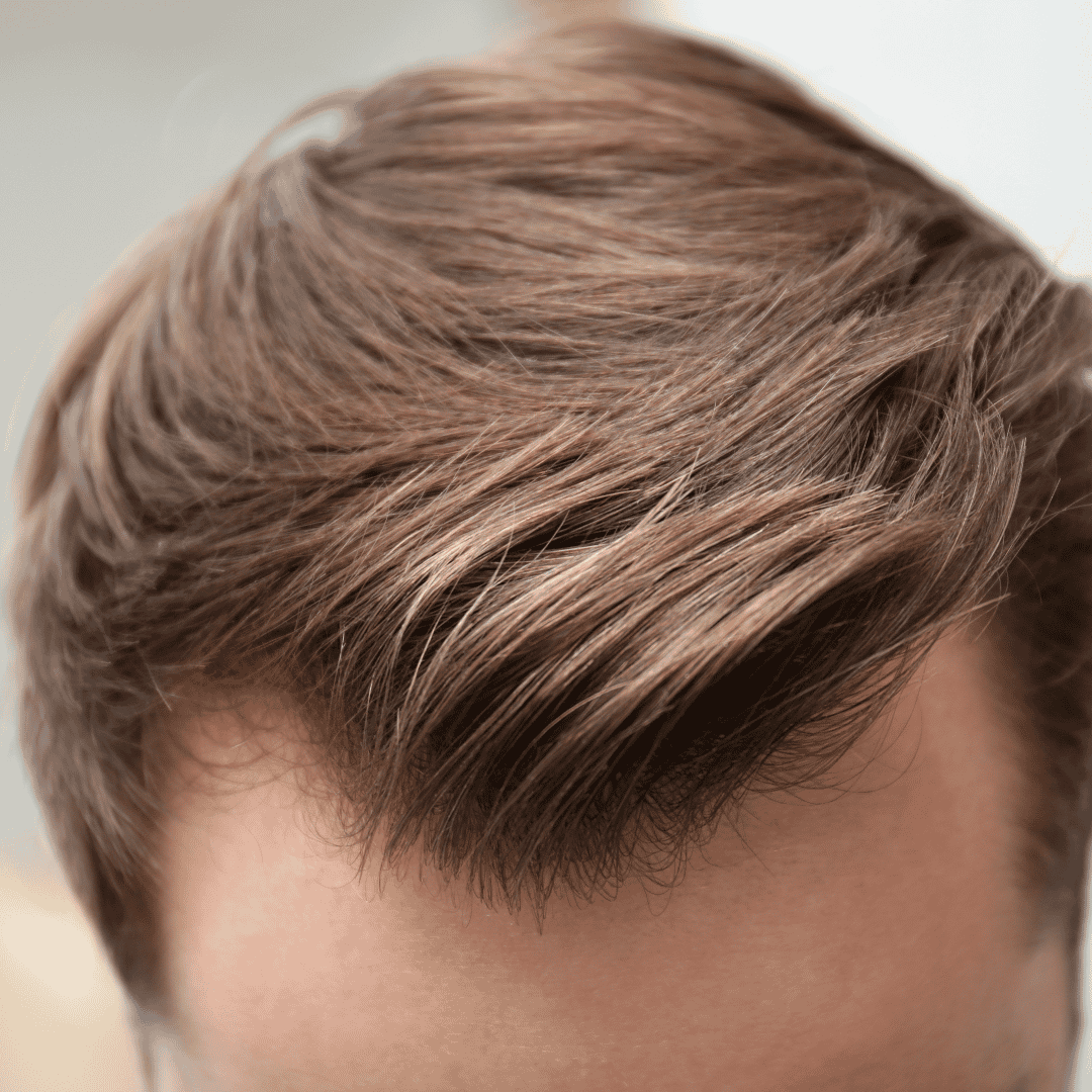 Trasplante de cabello FUE en Bellus Clinic: recupera tu cabello con Bellus Clinic