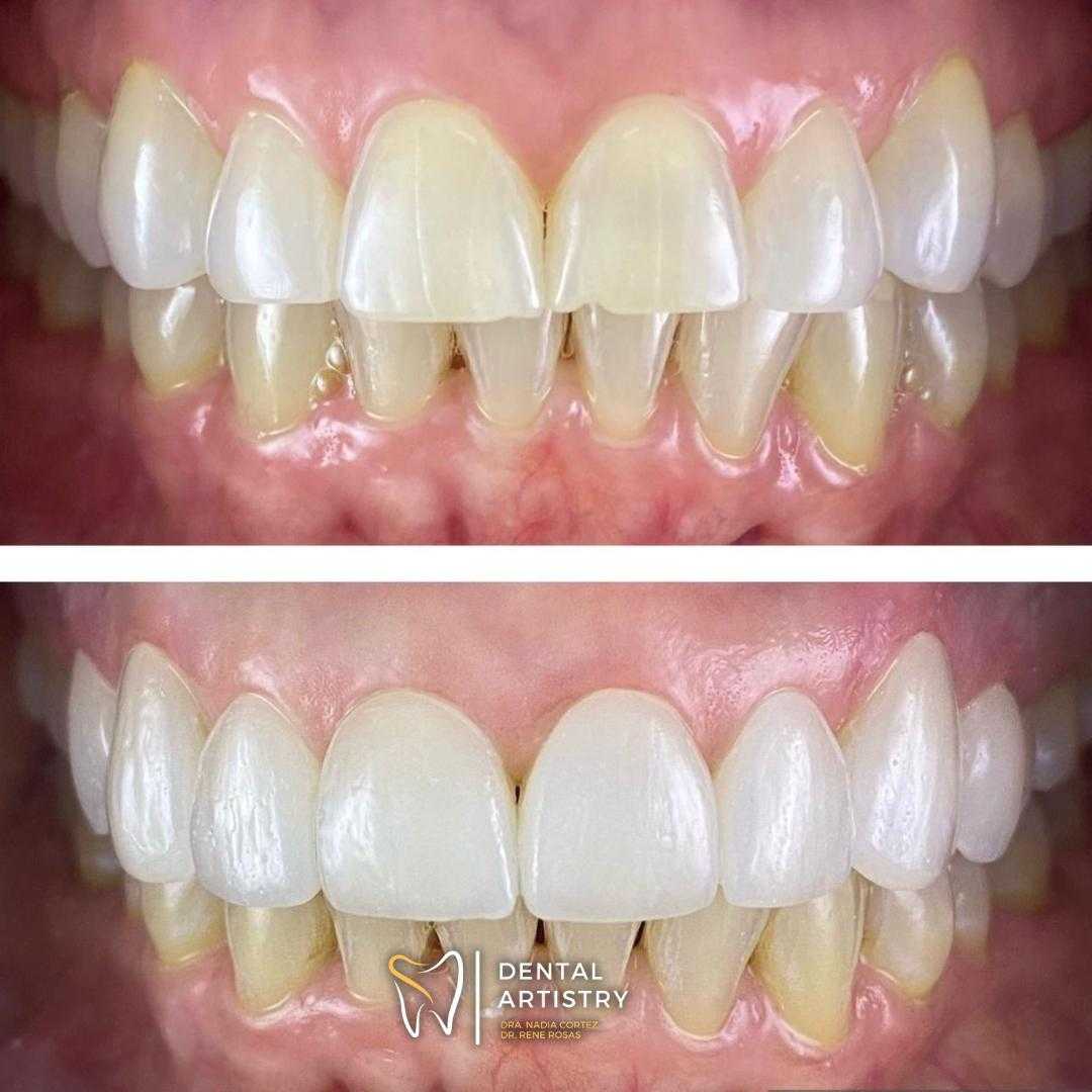 Paquete de empastes y uniones dentales en Nuevo Progreso, México