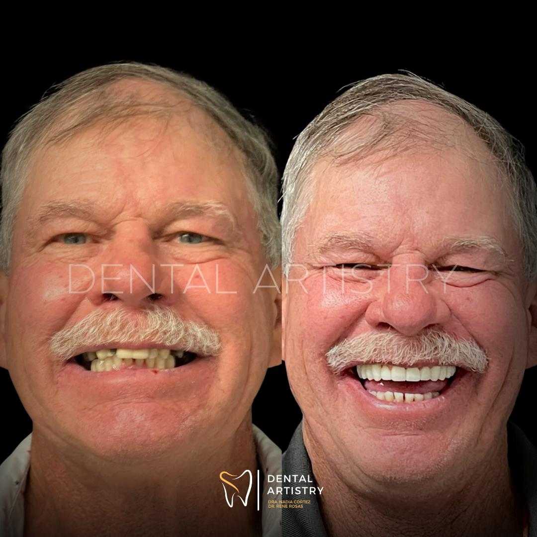 Implantes dentales asequibles de Dental Artistry y World Dental Center en Nuevo Progreso, México