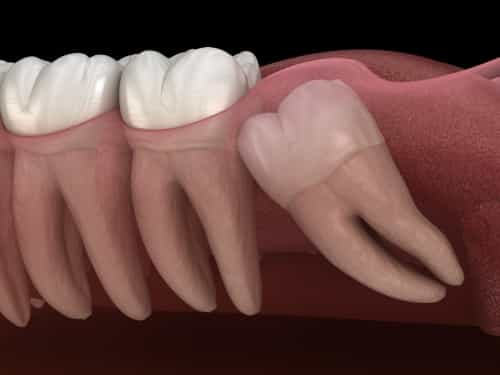 Paquete de extracción de muelas del juicio en Nuevo Progreso, México por Dental Artistry y World Dental Center