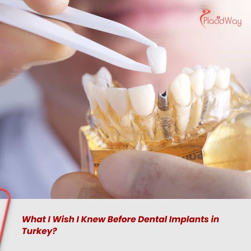¿Qué me hubiera gustado saber antes de ponerme implantes dentales en Turquía?