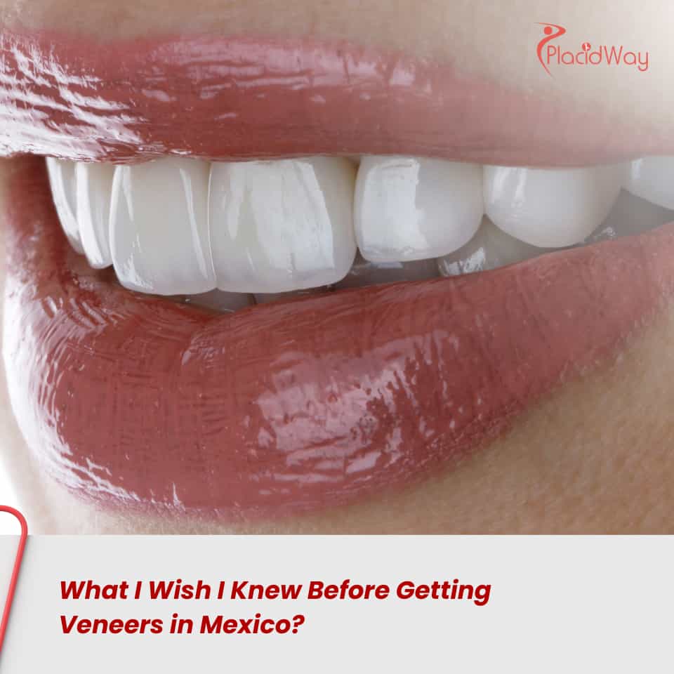 ¿Qué me hubiera gustado saber antes de hacerme carillas en México?